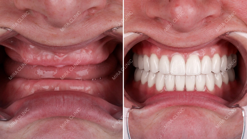 Full mouth Dental Implants